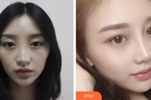 淮南麗顏醫(yī)療整形醫(yī)院呂永全整形價(jià)格表附鼻部綜合案例展示