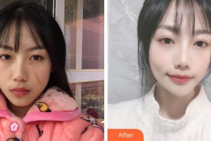 淮南市第一人民醫(yī)院燒傷整形科朱傳國(guó)整形價(jià)格表附微創(chuàng)疤痕修復(fù)案例展示