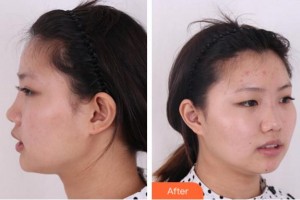 淮南金維整形醫(yī)院金輝家整形價(jià)格表附鼻部綜合案例展示