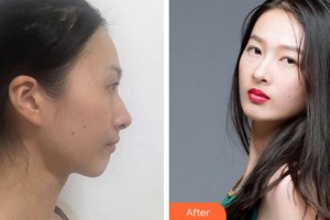 淮南凱婷美琪醫(yī)療美容醫(yī)院李立國(guó)整形價(jià)格表附鼻部綜合案例展示