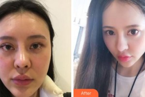 淮南凱婷美琪醫(yī)療美容醫(yī)院魯立菊整形價(jià)格表附埋線提升案例展示