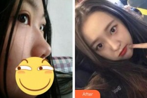 淮南凱婷美琪醫(yī)療美容醫(yī)院王清峰整形價(jià)格表附肋軟骨隆鼻案例展示