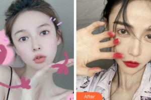 淮南麗顏醫(yī)療整形醫(yī)院劉建東整形價(jià)格表附耳軟骨復(fù)合隆鼻案例展示