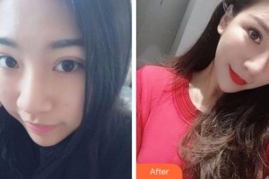 淮南麗顏醫(yī)療整形醫(yī)院張鵬鵬整形價(jià)格表附鼻部綜合案例展示