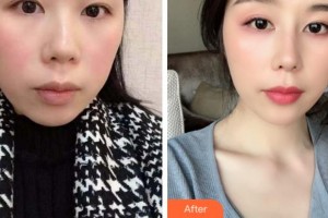 淮南麗顏醫(yī)療整形醫(yī)院陳愛寧整形價(jià)格表附鼻部綜合案例展示