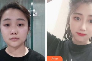 淮南美橙醫(yī)療整形美容醫(yī)院李韻芳整形價(jià)格表附肋軟骨隆鼻案例展示