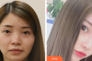 淮南美橙醫(yī)療整形美容醫(yī)院陳銘整形價(jià)格表附鼻部綜合案例展示