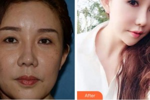 淮南澤明眼科醫(yī)院（原淮南東方醫(yī)院集團(tuán)眼科醫(yī)院）張玲整形價(jià)格表附外切祛眼袋案例展示