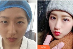 淮南華廈眼科醫(yī)院秦斌整形價(jià)格表附眼部綜合案例展示