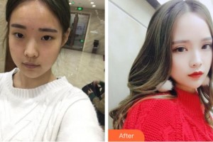 淮南華廈眼科醫(yī)院李波整形價(jià)格表附切開(kāi)雙眼皮案例展示