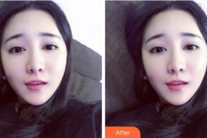 淮南華廈眼科醫(yī)院謝馳整形價(jià)格表附眼部整形案例展示