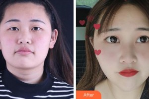 淮南澤明眼科醫(yī)院（原淮南東方醫(yī)院集團(tuán)眼科醫(yī)院）王丹梅整形價(jià)格表附眼部綜合案例展示