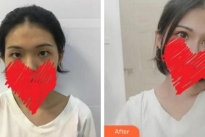 淮南澤明眼科醫(yī)院（原淮南東方醫(yī)院集團(tuán)眼科醫(yī)院）陳蓓莉整形價(jià)格表附切開(kāi)雙眼皮】案例展示