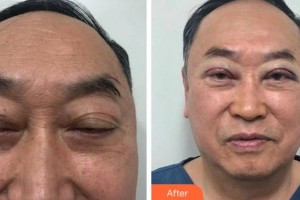 淮南澤明眼科醫(yī)院（原淮南東方醫(yī)院集團(tuán)眼科醫(yī)院）劉志剛整形價(jià)格表附切開(kāi)雙眼皮案例展示