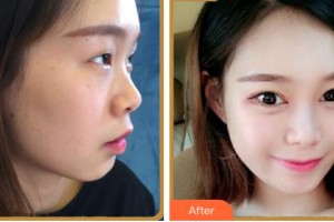 淮南澤明眼科醫(yī)院（原淮南東方醫(yī)院集團(tuán)眼科醫(yī)院）劉杰整形價(jià)格表附眼部綜合案例展示