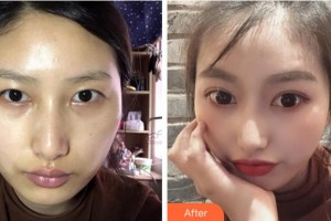 淮南澤明眼科醫(yī)院（原淮南東方醫(yī)院集團(tuán)眼科醫(yī)院）李福芝整形價(jià)格表附切開(kāi)雙眼皮案例展示