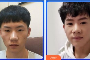 淮南澤明眼科醫(yī)院（原淮南東方醫(yī)院集團(tuán)眼科醫(yī)院）趙小妹整形價(jià)格表附雙眼皮案例展示