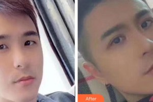 淮南晨光眼科醫(yī)院范敏整形價(jià)格表附眼部綜合案例展示