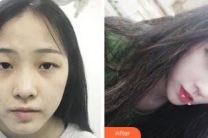 淮南晨光眼科醫(yī)院周本揚(yáng)整形價(jià)格表附切開(kāi)雙眼皮案例展示