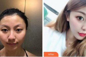 淮南晨光眼科醫(yī)院譚天住院醫(yī)師整形價(jià)格表附雙眼皮案例展示