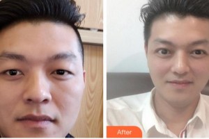 淮南華廈眼科醫(yī)院何曉勇整形價(jià)格表附切開(kāi)雙眼皮案例展示