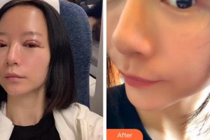 淮南華廈眼科醫(yī)院朱攀攀整形價(jià)格表附切開(kāi)雙眼皮案例展示