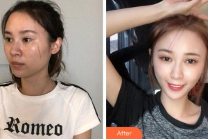 淮南東方醫(yī)院集團(tuán)總醫(yī)院燒傷整形科蔣新安整形價(jià)格表附點(diǎn)陣激光案例展示