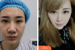 淮南新華醫(yī)院眼科李瓊整形價格表附眼部綜合案例展示