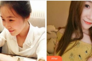 馬鞍山東方婦產(chǎn)醫(yī)院中韓整形美容中心吳堅(jiān)整形價格表附熱瑪吉案例展示