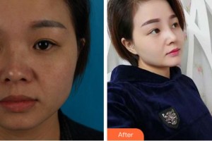 馬鞍山福華醫(yī)療美容醫(yī)院周曉晶整形價格表附耳軟骨復(fù)合隆鼻案例展示