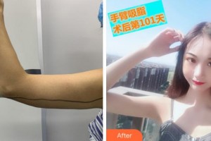 馬鞍山福華醫(yī)療美容醫(yī)院李建云整形價格表附美體塑形案例展示