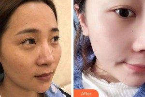 馬鞍山福華醫(yī)療美容醫(yī)院李剛整形價格表附鼻部綜合案例展示