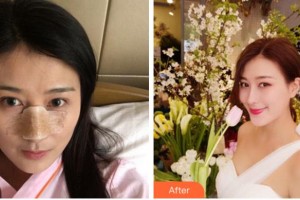 馬鞍山御星醫(yī)療美容醫(yī)院陳浩整形價格表附鼻部綜合案例展示