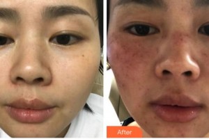 馬鞍山柯匯醫(yī)療美容醫(yī)院張志強整形價格表附激光美膚激光案例展示