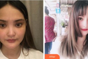 馬鞍山御星醫(yī)療美容醫(yī)院張少翔整形價格表附耳軟骨復合隆鼻案例展示