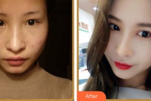 馬鞍山愛爾眼科醫(yī)院汪國飛整形價格表附眼部綜合案例展示