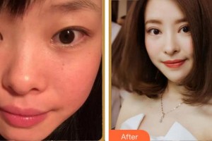 馬鞍山康視眼科醫(yī)院顧莉莉整形價格表附眼部綜合案例展示