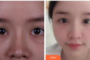 馬鞍山康視眼科醫(yī)院高衛(wèi)萍整形價格表附眼部修復案例展示