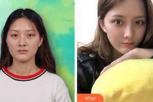 馬鞍山康視眼科醫(yī)院劉慶淮整形價格表附內(nèi)切祛眼袋案例展示