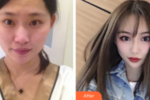 廣州求美醫(yī)學(xué)美容醫(yī)院黃紅云整形價(jià)格表附雙眼皮案例展示