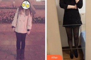 淮北東方美萊塢醫(yī)療美容醫(yī)院楊子偉整形價格表附吸脂案例展示