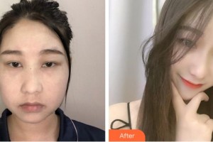 淮北東方美萊塢醫(yī)療美容醫(yī)院方芹整形價格表附埋線提升案例展示