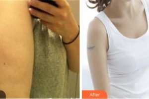 淮北東方美萊塢醫(yī)療美容醫(yī)院高敬鎬整形價格表附吸脂案例展示