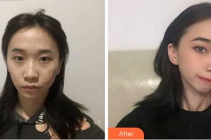 淮北東方美萊塢醫(yī)療美容醫(yī)院崔應(yīng)鈺整形價格表附微創(chuàng)疤痕修復(fù)案例展示