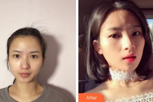 淮北天煌美容整形醫(yī)院吳雙純整形價格表附熱拉提案例展示