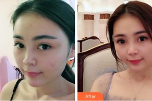 淮北奧斯曼醫(yī)療美容醫(yī)院任學(xué)東整形價格表附注射祛疤案例展示