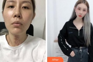 淮北時光整形美容醫(yī)院孟慶聚整形價格表附激光祛疤案例展示