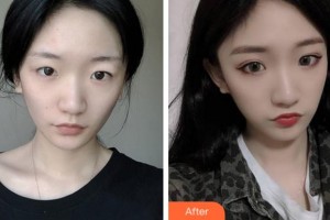 淮北市中醫(yī)院整形美容專科杜曉揚整形價格表附切開雙眼皮案例展示