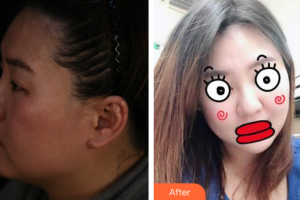 廣州海峽醫(yī)學(xué)整形美容醫(yī)院凌文娟整形價(jià)格表附埋線提升案例展示