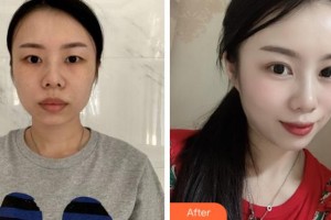 淮北東方美萊塢醫(yī)療美容醫(yī)院劉楠輝整形價(jià)格表附雙眼皮案例展示